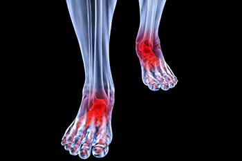 Arthritic foot and ankle care treatment in the Queens County, NY: Flushing (College Point, Linden Hill, Malba, Whitestone, Jackson Heights, Corona) and Elmhurst, NY (Forest Hills, Kew Garden Hills, Utopia, Murray Hills, Auburndale, Fresh Meadows, Sunnyside, Maspeth, Woodside) areas
